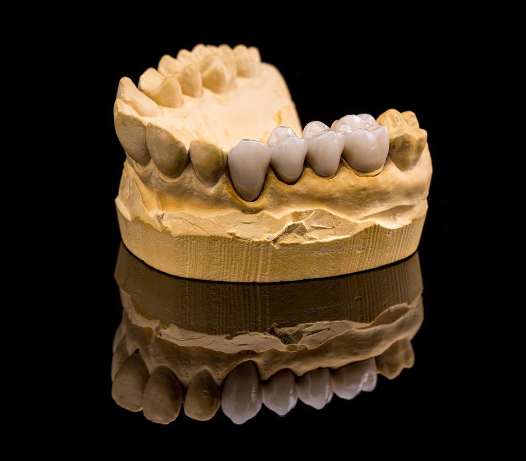 Zirconia Crowns in Alanya