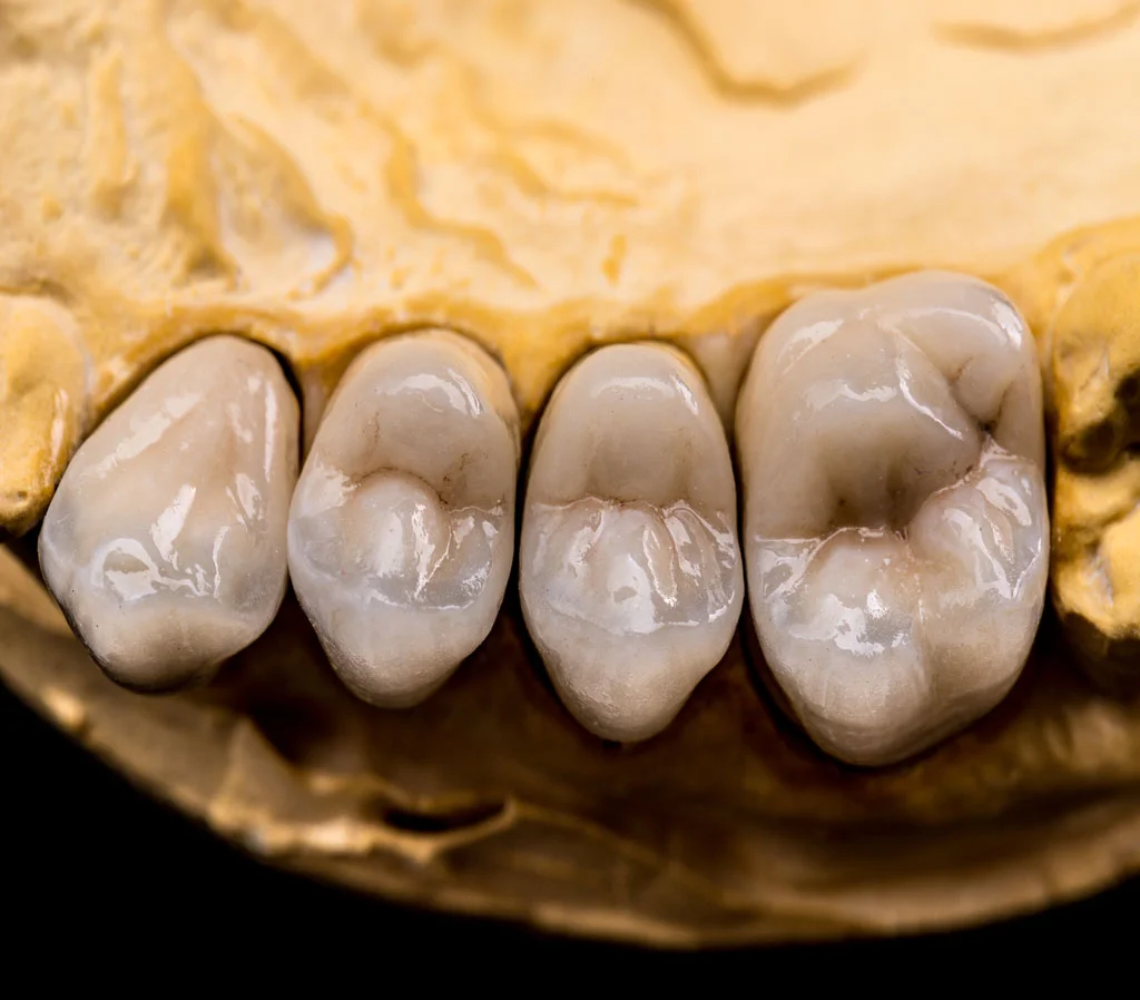 Couronne dentaire en zircone - Quels en sont les avantages ?