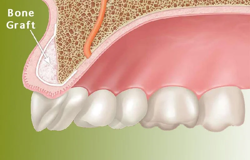 Костная пластика в стоматологии