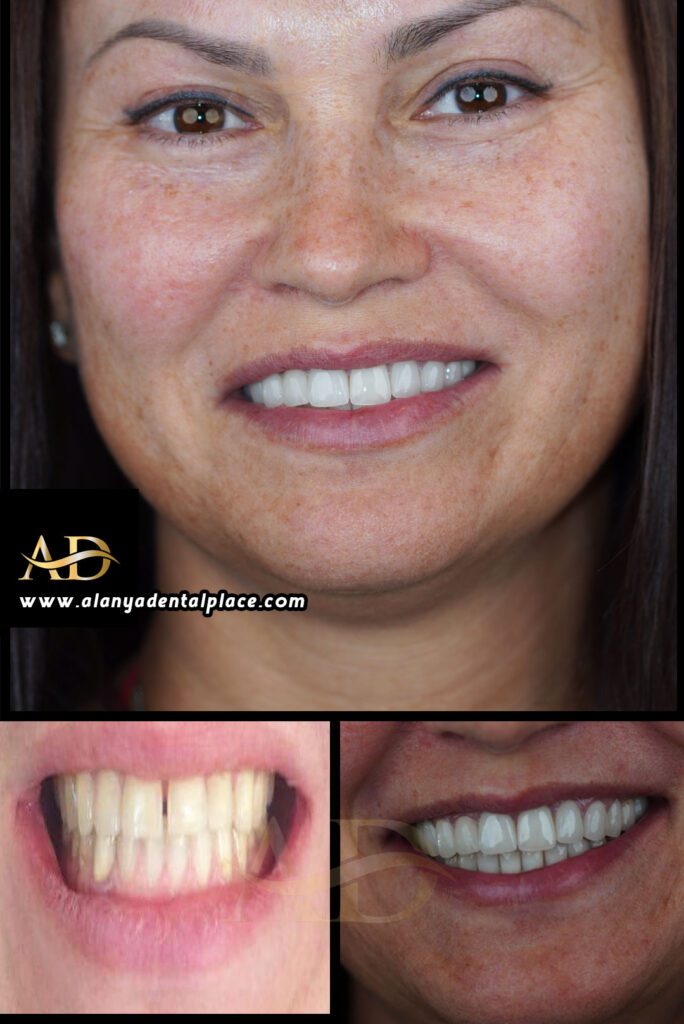 Before After Dental