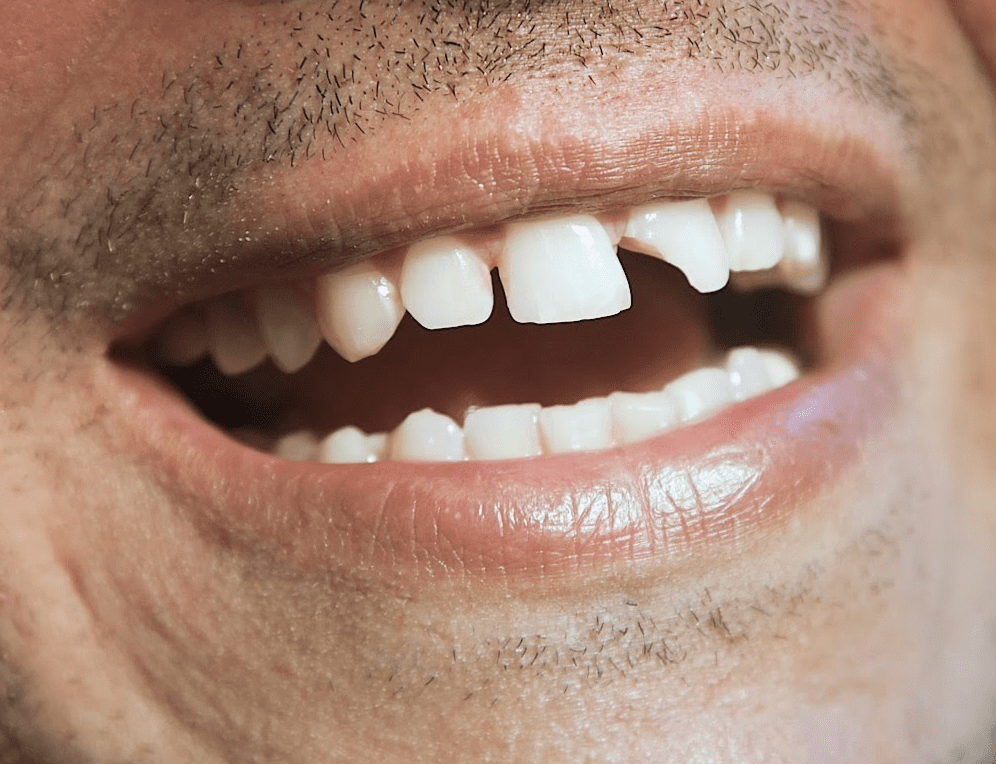 diş kırığı tedavisi nasıl yapılır