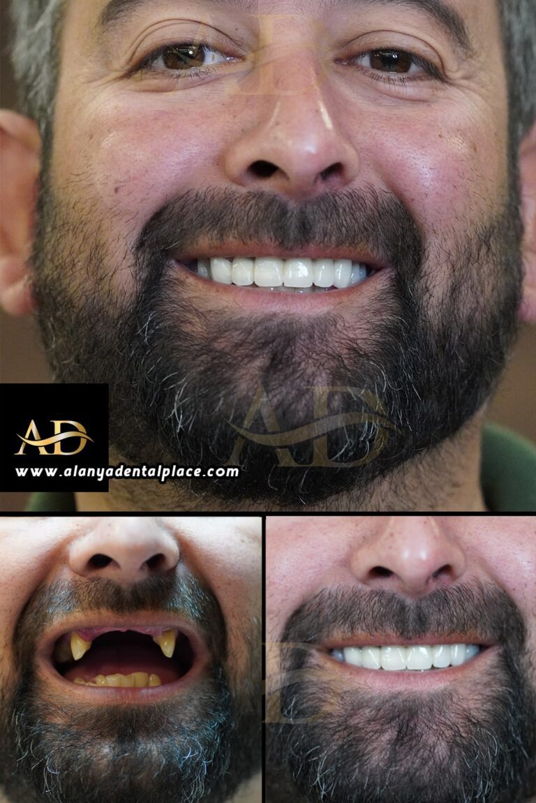 diş öncesi ve sonrası