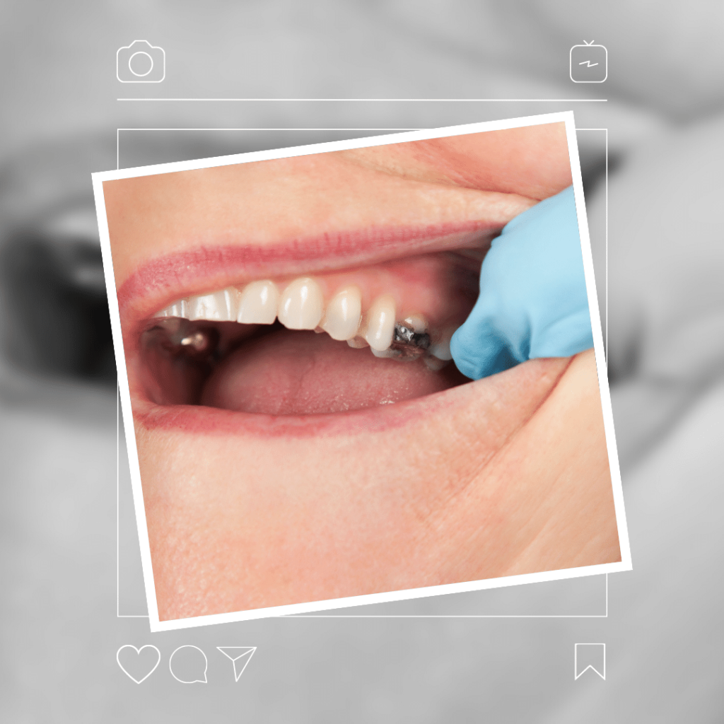 Tooth Decayed Treatment