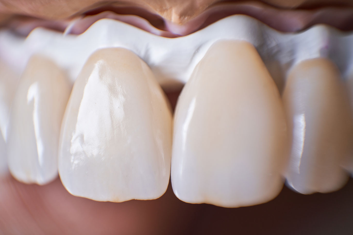 Arten von Zahnveneers und Preise für Zahnveneers