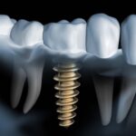 Was sind die durchschnittlichen Preise für Zahnimplantate?