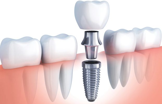 Vorteile von Zahnimplantaten und Antworten auf damit verbundene Fragen