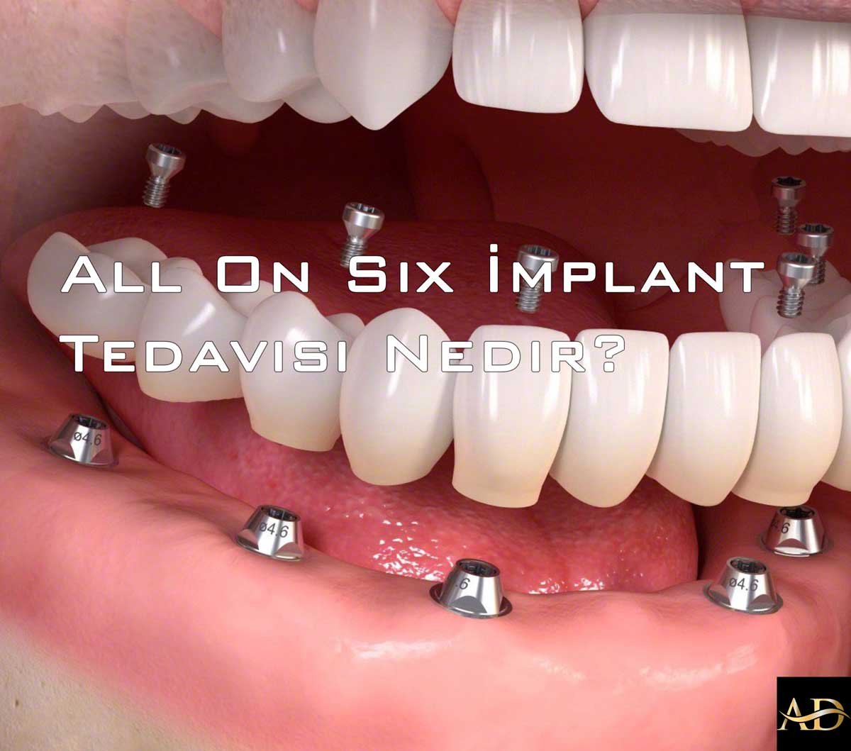 All On 6 Implant