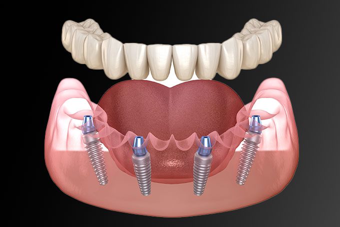 All On 4 Implants