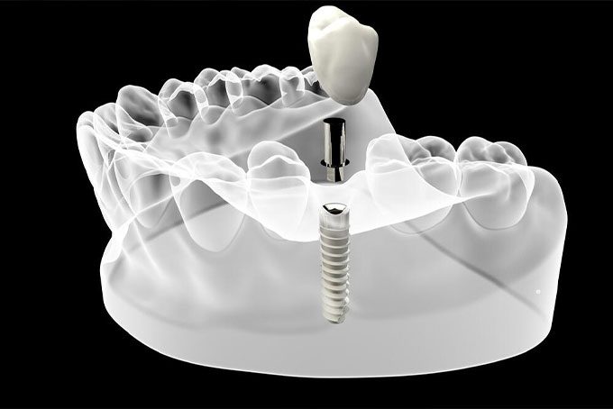 Dental Implants