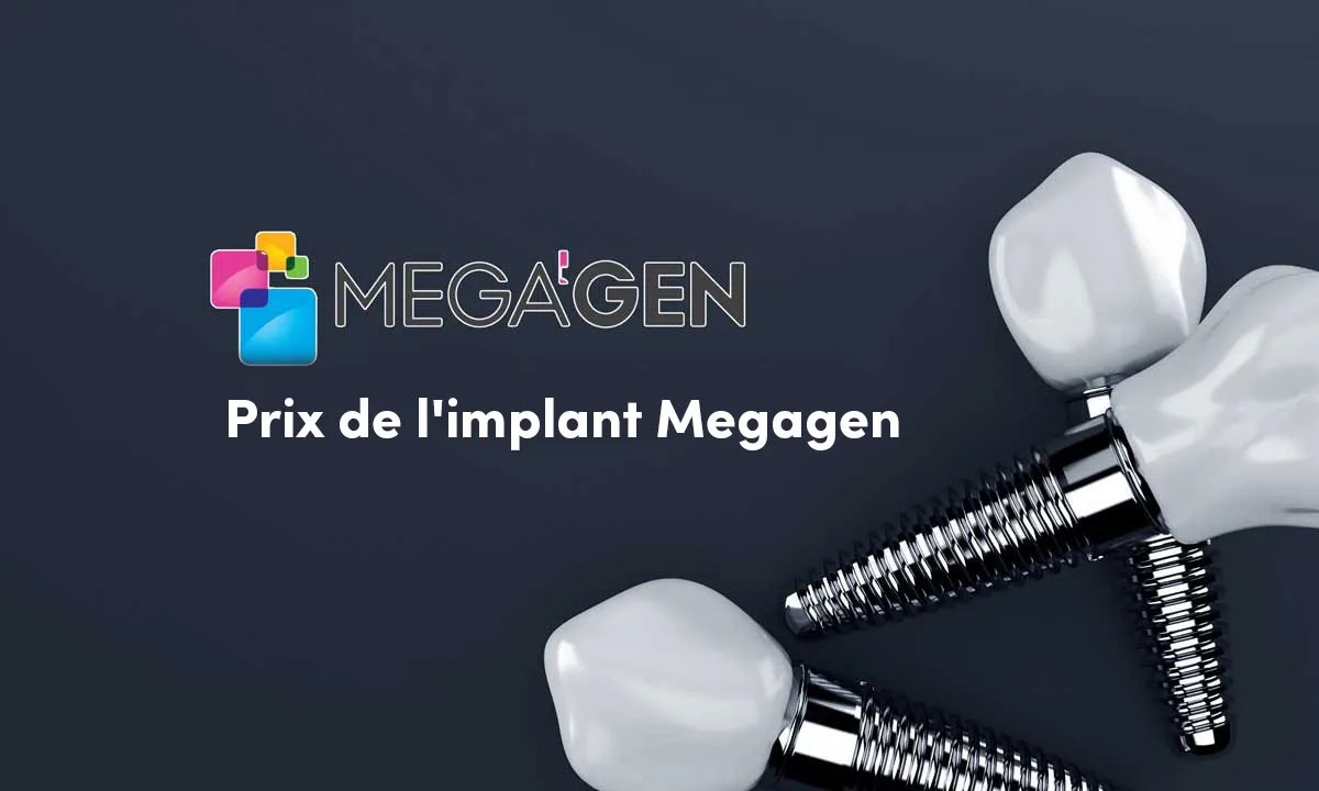 Types et Prix Des Implants Megagen