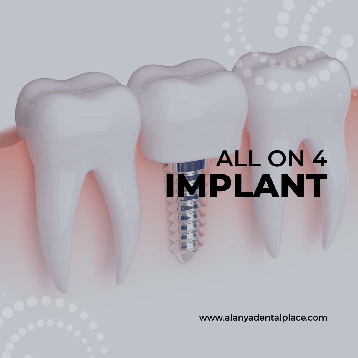 All On Four Dental Implant Turkey Antalya