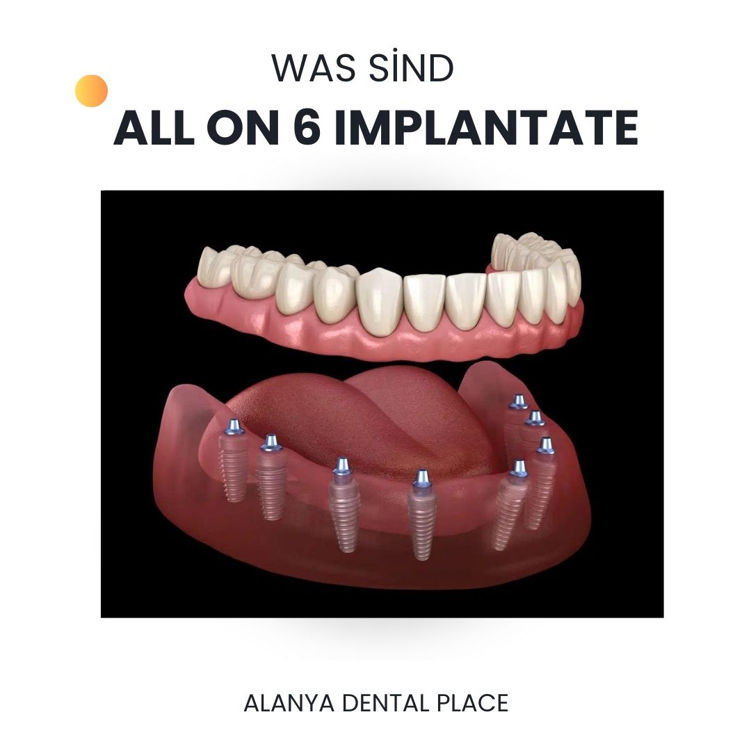 All On Six Implantatbehandlung
