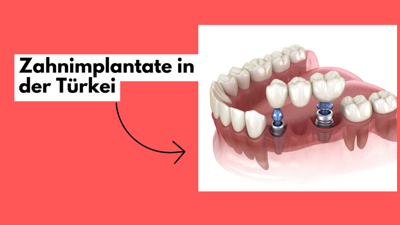Zahnimpantate in der Türkei